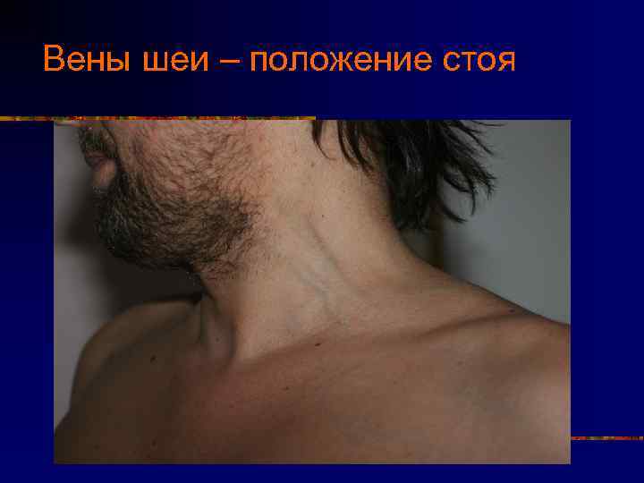 Вены шеи – положение стоя 