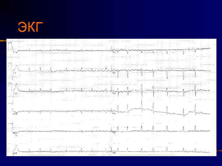 ЭКГ 