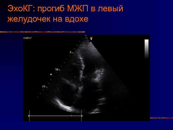 Эхо. КГ: прогиб МЖП в левый желудочек на вдохе 