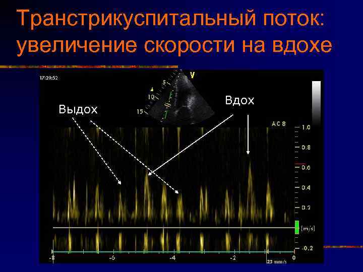 Транстрикуспитальный поток: увеличение скорости на вдохе Выдох Вдох 
