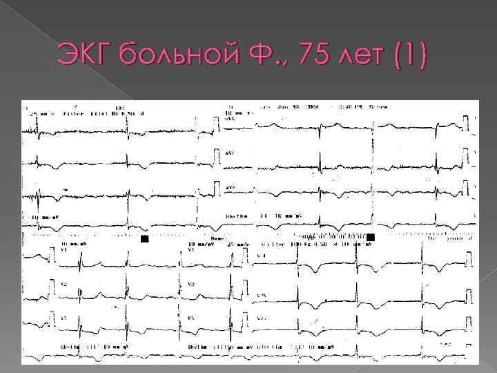 ЭКГ больной Ф. , 75 лет (1) 