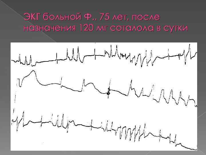 ЭКГ больной Ф. , 75 лет, после назначения 120 мг соталола в сутки 