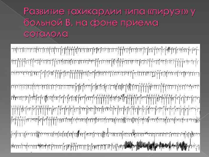 Тахикардия типа пируэт. Развитие тахикардии. Тахикардия типы. Тахикардия Пируэт.