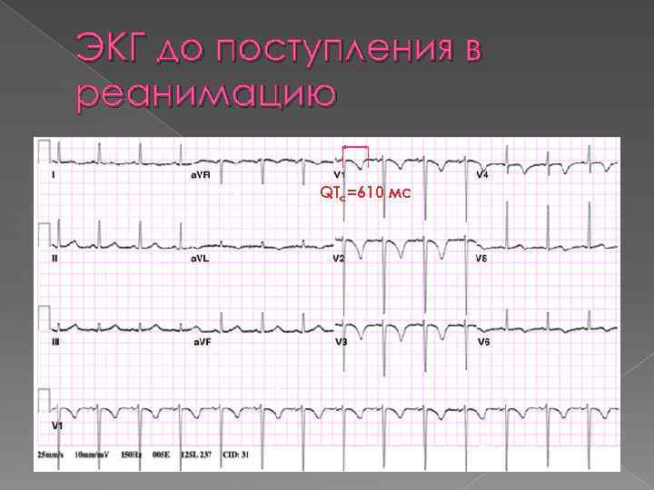 ЭКГ до поступления в реанимацию QTc=610 мс 