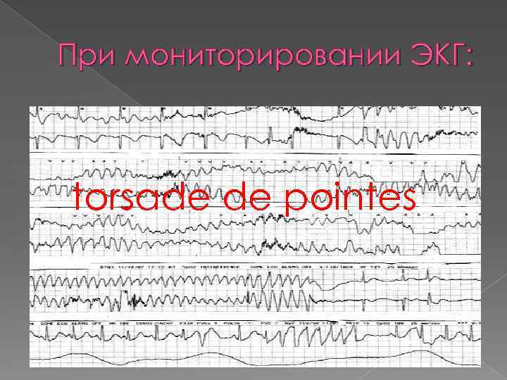 При мониторировании ЭКГ: torsade de pointes 