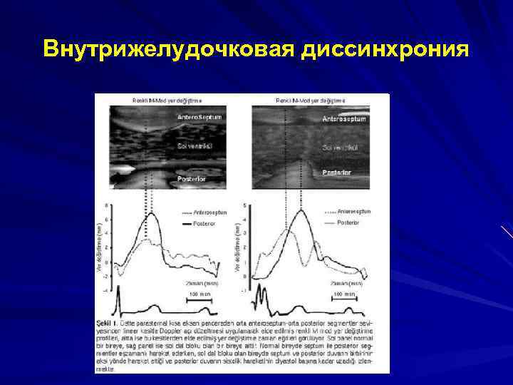 Внутрижелудочковая диссинхрония 