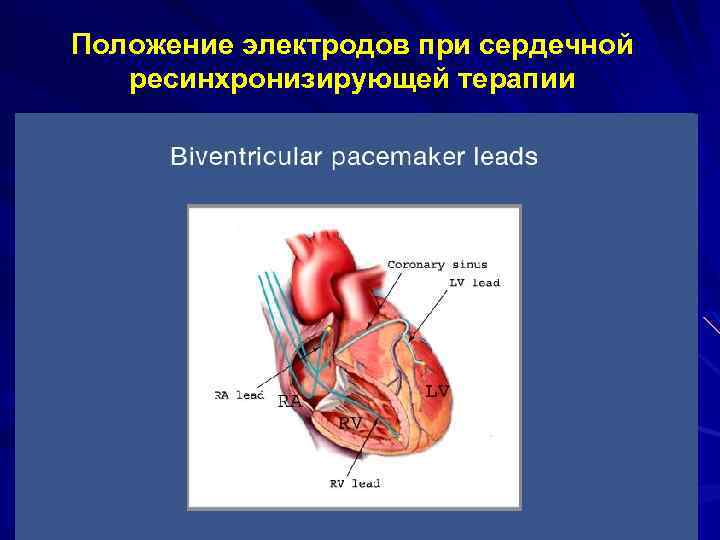 Положение электродов при сердечной ресинхронизирующей терапии 