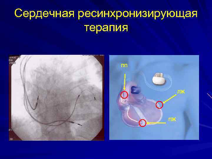 Сердечная ресинхронизирующая терапия ПП ЛЖ ПЖ 