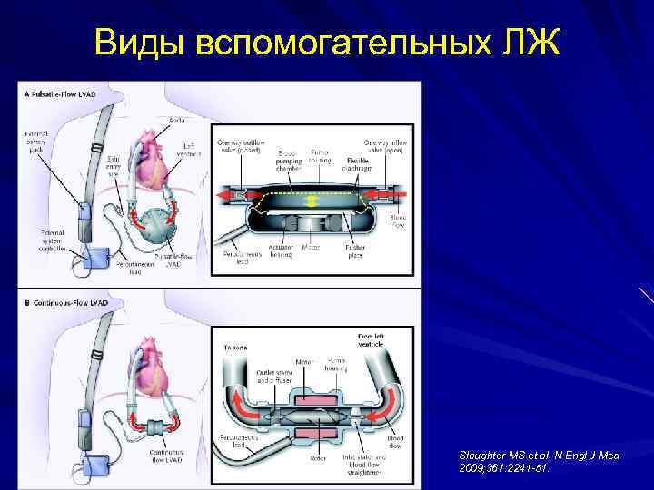 Виды вспомогательных ЛЖ Slaughter MS et al. N Engl J Med 2009; 361: 2241