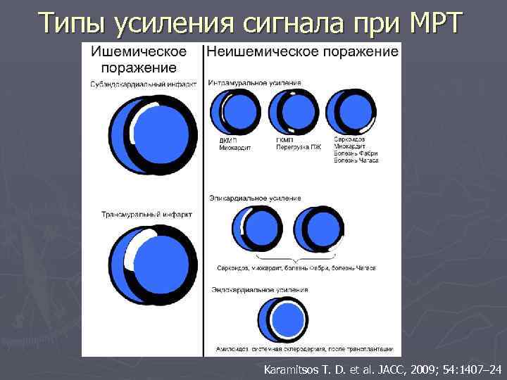 Типы усиления сигнала при МРТ Karamitsos T. D. et al. JACC, 2009; 54: 1407–