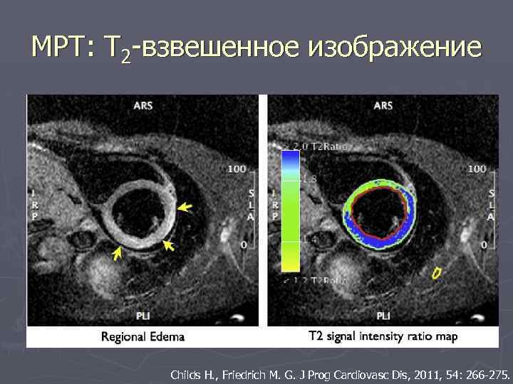 МРТ: Т 2 -взвешенное изображение Childs H. , Friedrich M. G. J Prog Cardiovasc