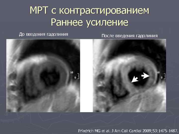 МРТ с контрастированием Раннее усиление До введения гадолиния После введения гадолиния Friedrich MG et