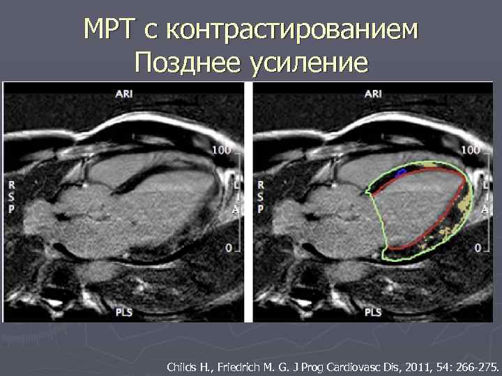 МРТ с контрастированием Позднее усиление Childs H. , Friedrich M. G. J Prog Cardiovasc