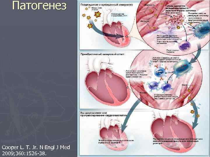 Патогенез Cooper L. T. Jr. N Engl J Med 2009; 360: 1526 -38. 