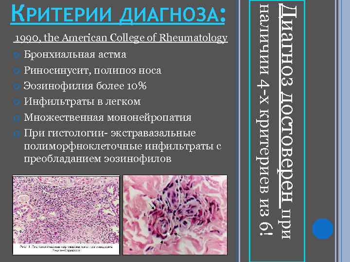  1990, the American College of Rheumatology Бронхиальная астма Риносинусит, полипоз носа Эозинофилия более