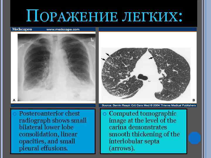 ПОРАЖЕНИЕ ЛЕГКИХ: Posteroanterior chest radiograph shows small bilateral lower lobe consolidation, linear opacities, and