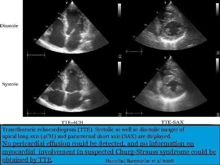 Transthoracic echocardiogram (TTE). Systolic as well as diastolic images of apical long axis (4