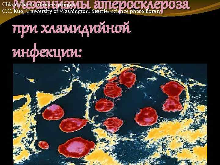 Механизмы атеросклероза при хламидийной инфекции: Chlamydia in coronary plaque. C. C. Kuo, Uniwersity of