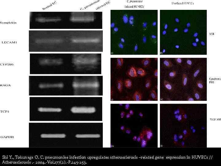 Shi Y. , Tokunaga O. C. pneumoniae infection upregulates atherosclerosis –related gene expression in