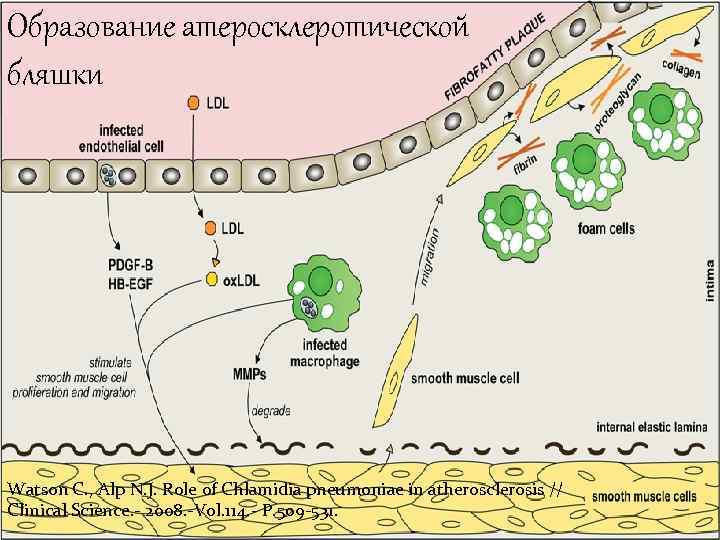 Образование атеросклеротической бляшки Watson C. , Alp N. J. Role of Chlamidia pneumoniae in