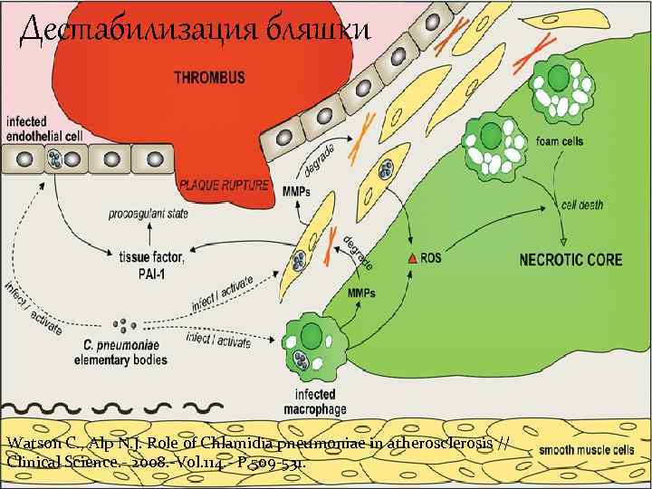 Дестабилизация бляшки Watson C. , Alp N. J. Role of Chlamidia pneumoniae in atherosclerosis