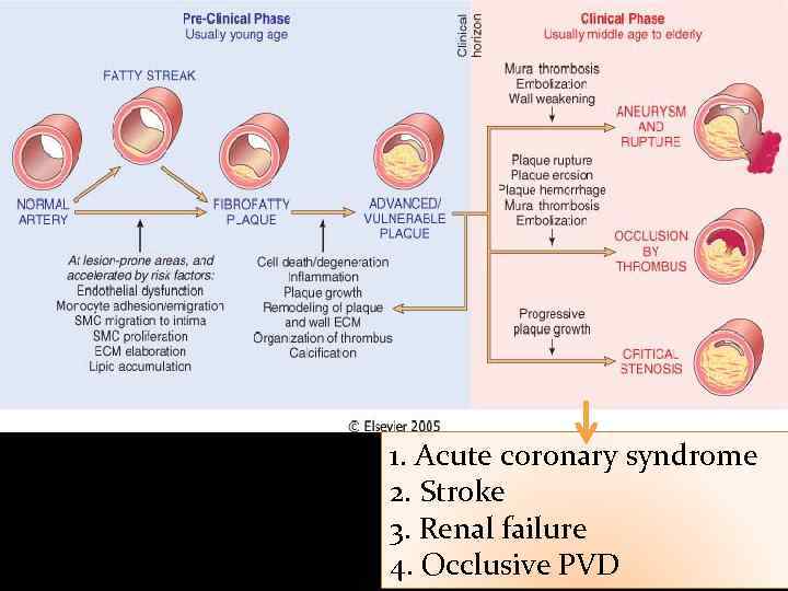 1. Acute coronary syndrome 2. Stroke 3. Renal failure 4. Occlusive PVD 