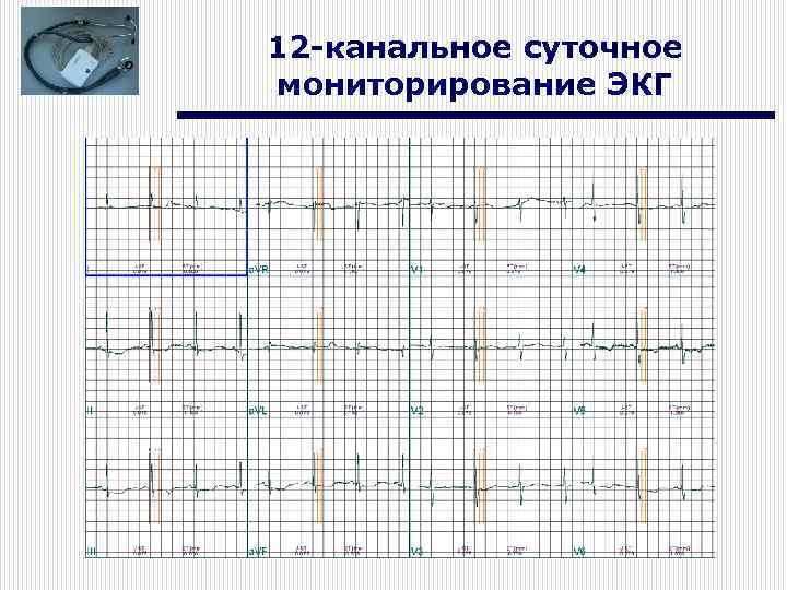 12 -канальное суточное мониторирование ЭКГ 