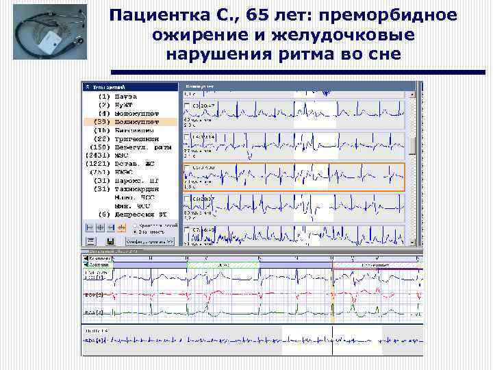 Пациентка С. , 65 лет: преморбидное ожирение и желудочковые нарушения ритма во сне 