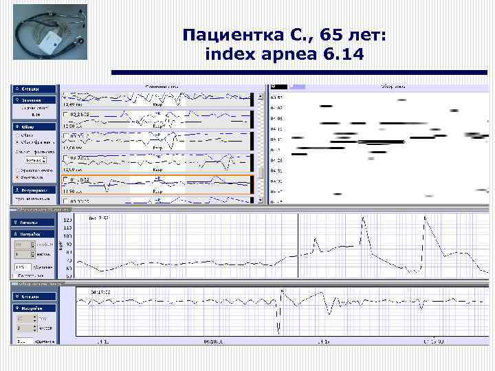 Пациентка С. , 65 лет: index apnea 6. 14 