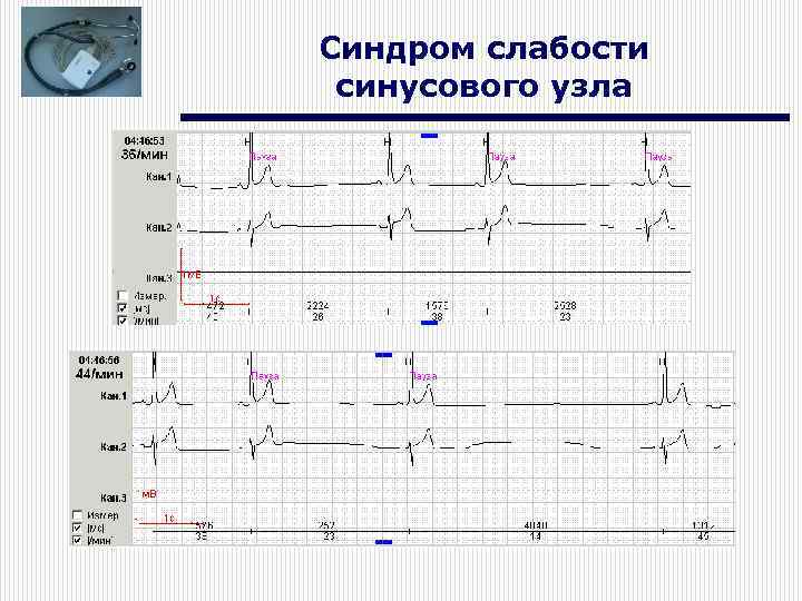 Синдром слабости синусового узла 