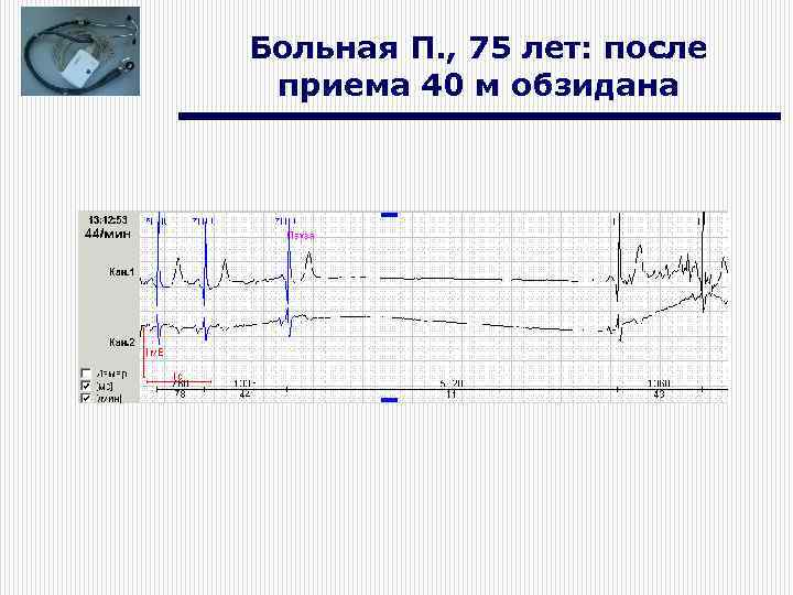 Больная П. , 75 лет: после приема 40 м обзидана 