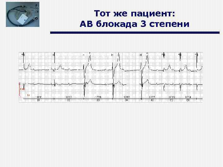 Тот же пациент: АВ блокада 3 степени 