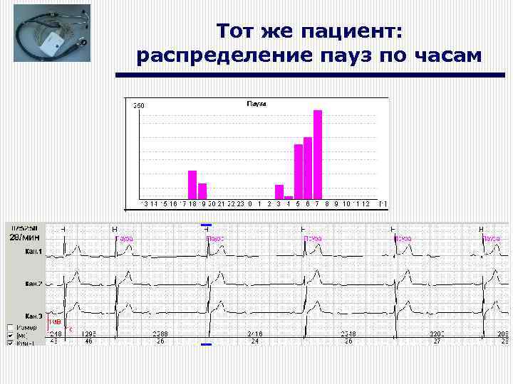 Тот же пациент: распределение пауз по часам 