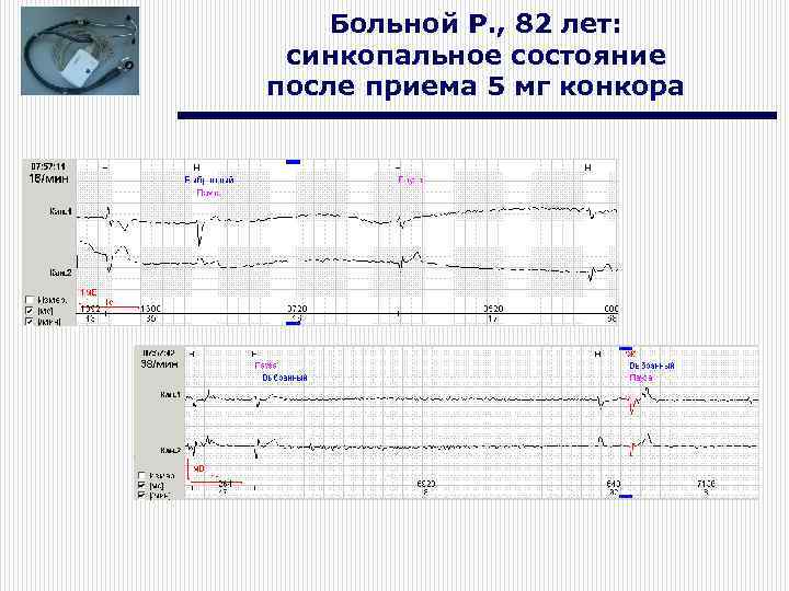 Больной Р. , 82 лет: синкопальное состояние после приема 5 мг конкора 