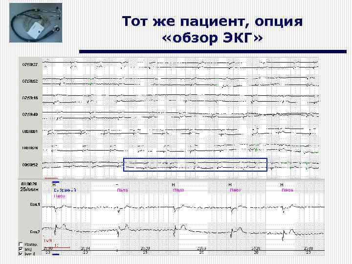 Тот же пациент, опция «обзор ЭКГ» 