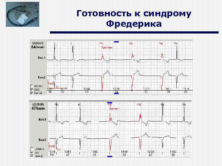 Готовность к синдрому Фредерика 