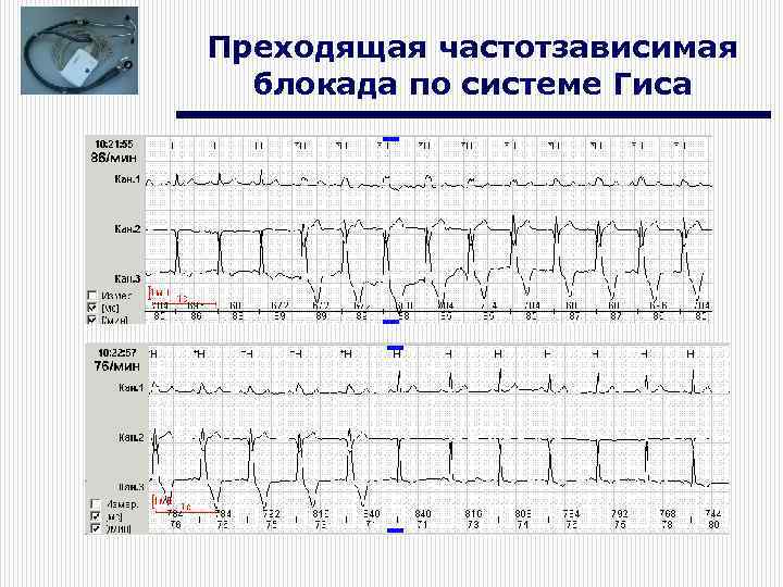 Преходящая частотзависимая блокада по системе Гиса 
