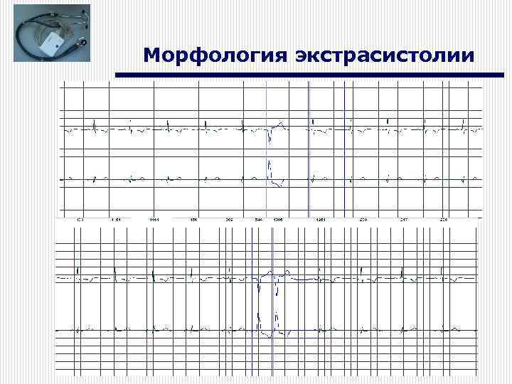Морфология экстрасистолии 