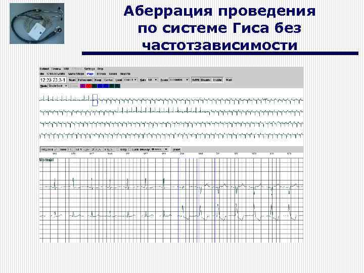 Аберрация проведения по системе Гиса без частотзависимости 