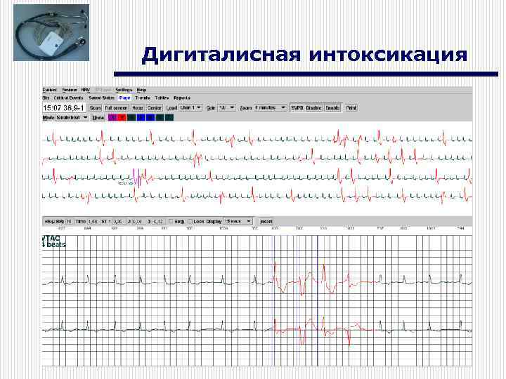Дигиталисная интоксикация 