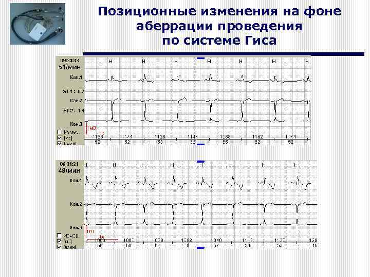 Позиционные изменения на фоне аберрации проведения по системе Гиса 