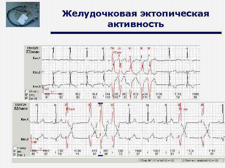 Желудочковая эктопическая активность 