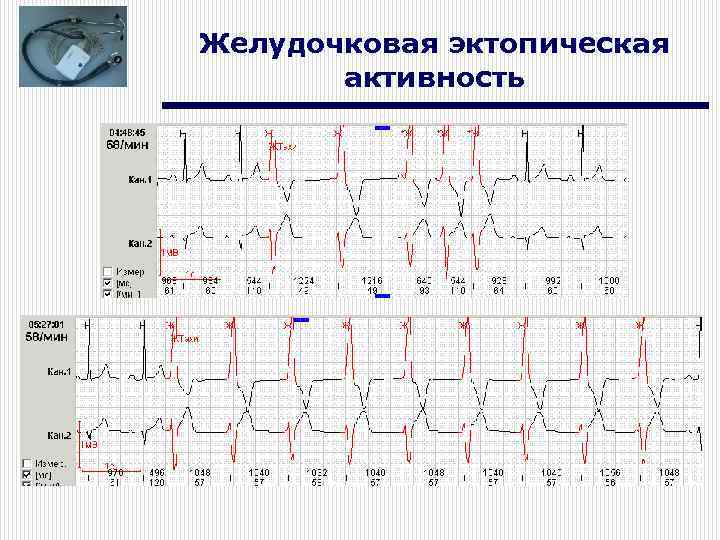 Желудочковая эктопическая активность 