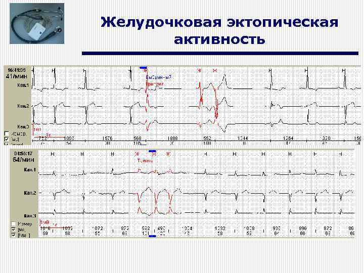 Желудочковая эктопическая активность 
