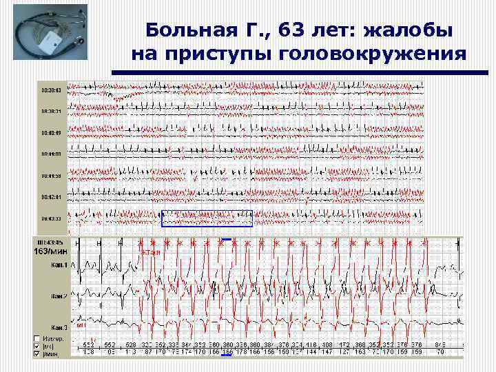 Больная Г. , 63 лет: жалобы на приступы головокружения 