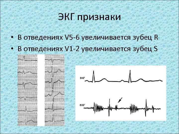 ЭКГ признаки • В отведениях V 5 -6 увеличивается зубец R • В отведениях