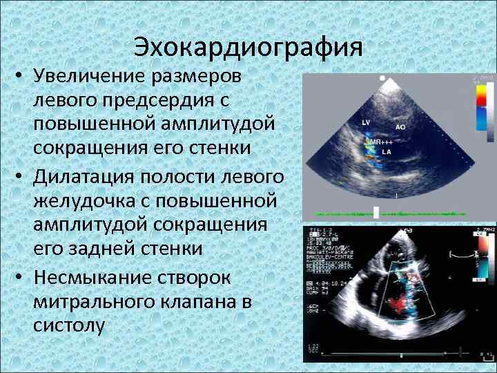 Эхокардиография • Увеличение размеров левого предсердия с повышенной амплитудой сокращения его стенки • Дилатация