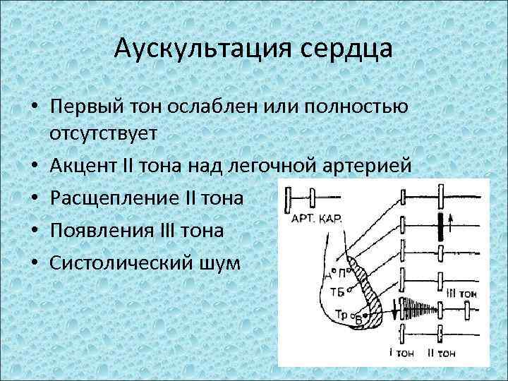 Аускультация сердца • Первый тон ослаблен или полностью отсутствует • Акцент II тона над