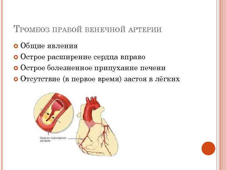 ТРОМБОЗ ПРАВОЙ ВЕНЕЧНОЙ АРТЕРИИ Общие явления Острое расширение сердца вправо Острое болезненное припухание печени