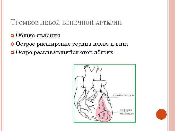 Сердечный тромбоз. Тромбоз левой венечной артерии. Острое расширение сердца. Тромб венечной артерии сердца. Расширение сердца влево и вниз.